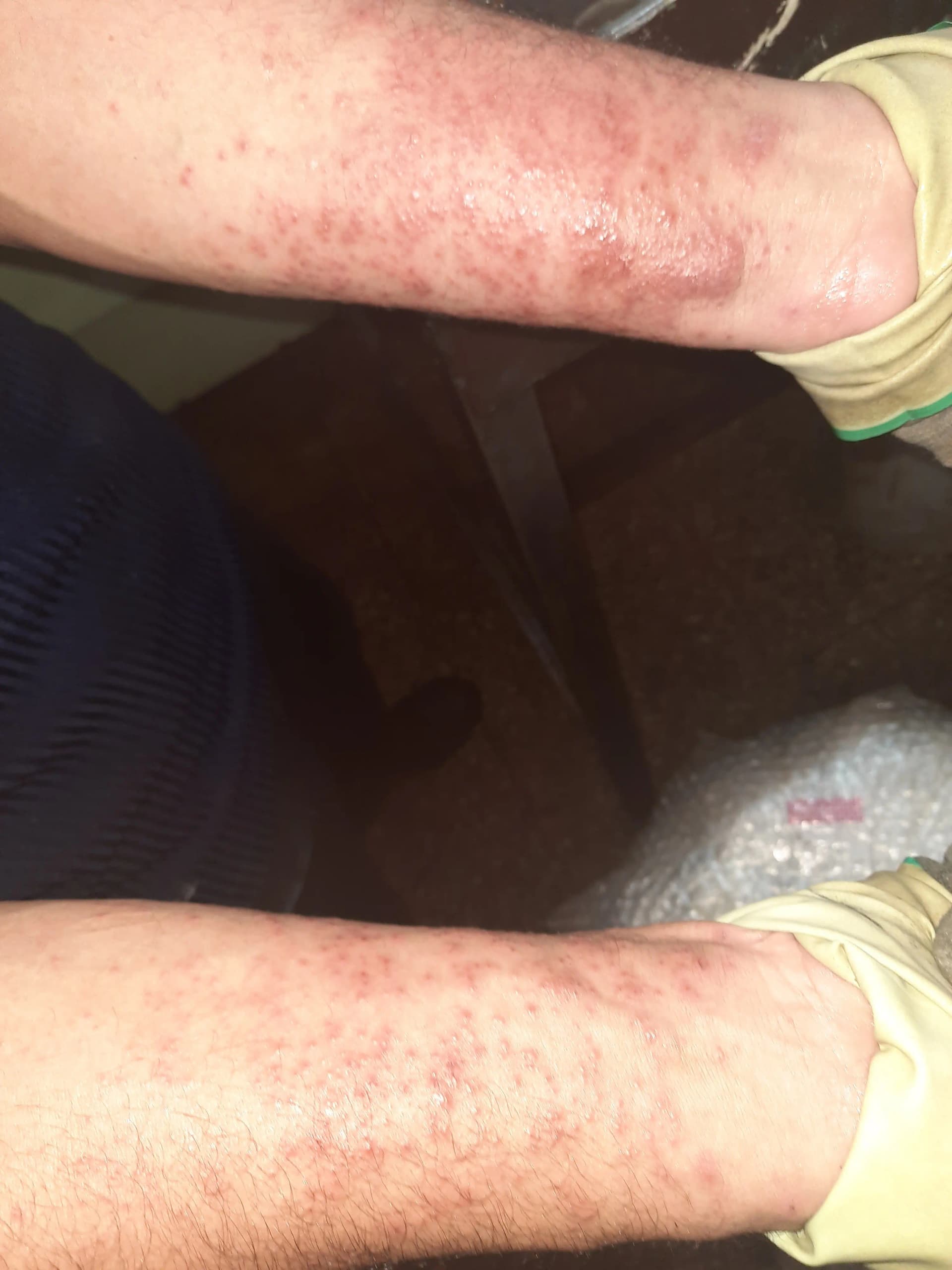 حساسیت پوستی